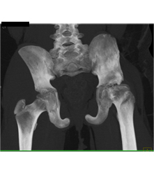 Left Hip Dysplasia Due to Earlier Avascular Necrosis (AVN). Multiple Renderings Include Bone Removal. See Full Sequence of Images - CTisus CT Scan