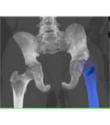 Left Hip Dysplasia Due to Earlier Avascular Necrosis (AVN). Multiple Renderings Include Bone Removal. See Full Sequence of Images - CTisus CT Scan