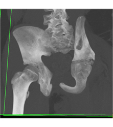 Left Hip Dysplasia Due to Earlier Avascular Necrosis (AVN). Multiple Renderings Include Bone Removal. See Full Sequence of Images - CTisus CT Scan