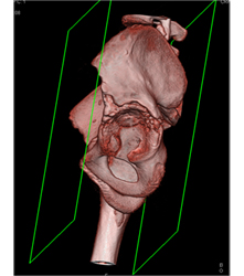 Left Hip Dysplasia Due to Earlier Avascular Necrosis (AVN). Multiple Renderings Include Bone Removal. See Full Sequence of Images - CTisus CT Scan