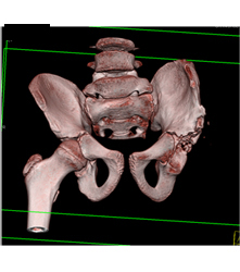 Left Hip Dysplasia Due to Earlier Avascular Necrosis (AVN). Multiple Renderings Include Bone Removal. See Full Sequence of Images - CTisus CT Scan