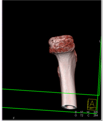 Left Hip Dysplasia Due to Earlier Avascular Necrosis (AVN). Multiple Renderings Include Bone Removal. See Full Sequence of Images - CTisus CT Scan