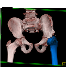 Left Hip Dysplasia Due to Earlier Avascular Necrosis (AVN). Multiple Renderings Include Bone Removal. See Full Sequence of Images - CTisus CT Scan