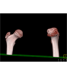 Left Hip Dysplasia Due to Earlier Avascular Necrosis (AVN). Multiple Renderings Include Bone Removal. See Full Sequence of Images - CTisus CT Scan