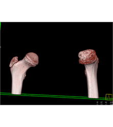 Left Hip Dysplasia Due to Earlier Avascular Necrosis (AVN). Multiple Renderings Include Bone Removal. See Full Sequence of Images - CTisus CT Scan