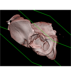 Left Hip Dysplasia Due to Earlier Avascular Necrosis (AVN). Multiple Renderings Include Bone Removal. See Full Sequence of Images - CTisus CT Scan