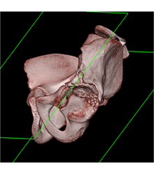 Left Hip Dysplasia Due to Earlier Avascular Necrosis (AVN). Multiple Renderings Include Bone Removal. See Full Sequence of Images - CTisus CT Scan