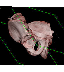 Left Hip Dysplasia Due to Earlier Avascular Necrosis (AVN). Multiple Renderings Include Bone Removal. See Full Sequence of Images - CTisus CT Scan