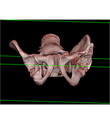 Left Hip Dysplasia Due to Earlier Avascular Necrosis (AVN). Multiple Renderings Include Bone Removal. See Full Sequence of Images - CTisus CT Scan