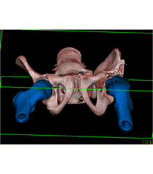 Left Hip Dysplasia Due to Earlier Avascular Necrosis (AVN). Multiple Renderings Include Bone Removal. See Full Sequence of Images - CTisus CT Scan