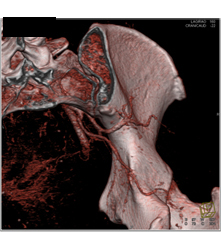 Sgap Flap Planning - CTisus CT Scan