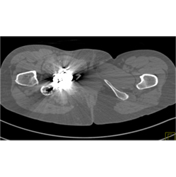 Pelvic Arteriovenous Malformation (AVM) With Prior Embolization. Note Boney Changes as Well. Images Include Bone Editing as Well - CTisus CT Scan