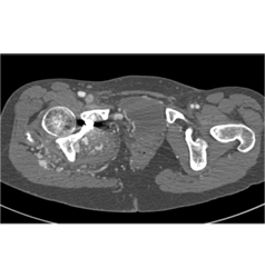 Pelvic Arteriovenous Malformation (AVM) With Prior Embolization. Note Boney Changes as Well. Images Include Bone Editing as Well - CTisus CT Scan