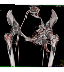 Pelvic Arteriovenous Malformation (AVM) With Prior Embolization. Note Boney Changes as Well. Images Include Bone Editing as Well - CTisus CT Scan