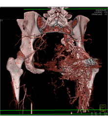 Pelvic Arteriovenous Malformation (AVM) With Prior Embolization. Note Boney Changes as Well. Images Include Bone Editing as Well - CTisus CT Scan