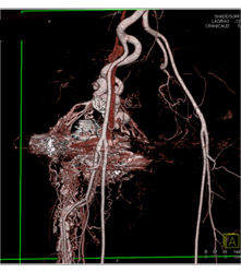 Pelvic Arteriovenous Malformation (AVM) With Prior Embolization. Note Boney Changes as Well. Images Include Bone Editing as Well - CTisus CT Scan