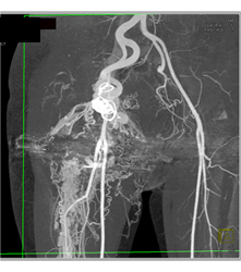 Pelvic Arteriovenous Malformation (AVM) With Prior Embolization. Note Boney Changes as Well. Images Include Bone Editing as Well - CTisus CT Scan