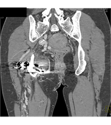 Pelvic Arteriovenous Malformation (AVM) With Prior Embolization. Note Boney Changes as Well. Images Include Bone Editing as Well - CTisus CT Scan