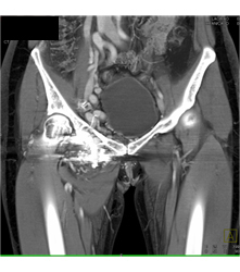 Pelvic Arteriovenous Malformation (AVM) With Prior Embolization. Note Boney Changes as Well. Images Include Bone Editing as Well - CTisus CT Scan