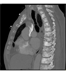 Wide Spread Bone Metastases From Prostate Cancer - CTisus CT Scan