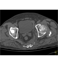 Sacral Fracture With Hematoma - CTisus CT Scan