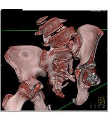 Sacral Dysplasia - CTisus CT Scan