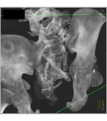 Sacral Dysplasia - CTisus CT Scan