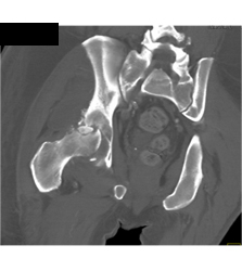 Hip Fracture - CTisus CT Scan