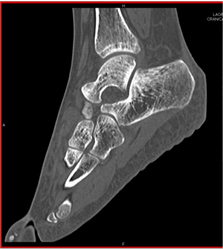 Calcaneal Fracture - CTisus CT Scan