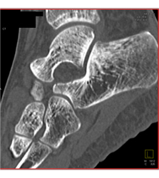 Calcaneal Fracture - CTisus CT Scan