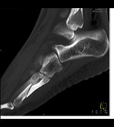 Fracture of 5th Metatarsal - CTisus CT Scan