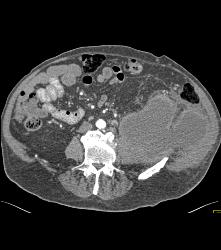 Abscess Invades Psoas and Abdominal Wall - CTisus CT Scan