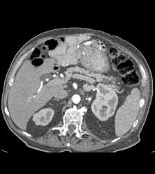 Abscess Invades Psoas and Abdominal Wall - CTisus CT Scan