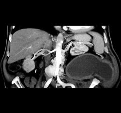 Abscess Invades Psoas and Abdominal Wall - CTisus CT Scan