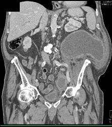 Abscess Invades Psoas and Abdominal Wall - CTisus CT Scan