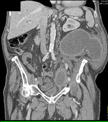 Abscess Invades Psoas and Abdominal Wall - CTisus CT Scan