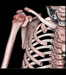 Exostosis Off Scapula With 3D Pre-op Planning - CTisus CT Scan