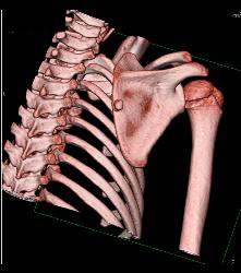 Exostosis Off Scapula With 3D Pre-op Planning - CTisus CT Scan