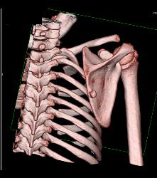 Exostosis Off Scapula With 3D Pre-op Planning - CTisus CT Scan