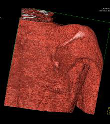 Exostosis Off Scapula With 3D Pre-op Planning - CTisus CT Scan