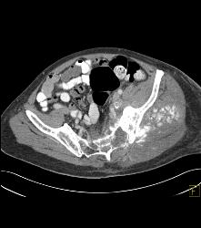 Osteosarcoma - CTisus CT Scan