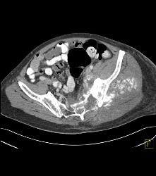 Osteosarcoma - CTisus CT Scan