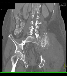 Osteosarcoma - CTisus CT Scan