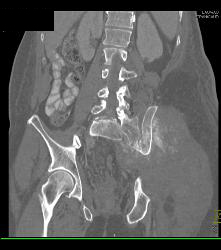 Osteosarcoma - CTisus CT Scan