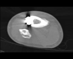 Nonunion Tibial Fracture - CTisus CT Scan