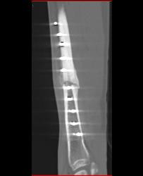 Nonunion Tibial Fracture - CTisus CT Scan