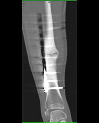 Nonunion Tibial Fracture - CTisus CT Scan