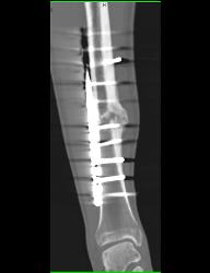 Nonunion Tibial Fracture - CTisus CT Scan