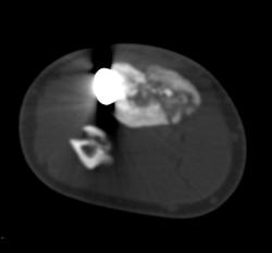 Nonunion Tibial Fracture - CTisus CT Scan