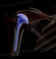 Metal Reduction for Shoulder Replacement - CTisus CT Scan